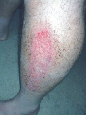 Softball sliding strawberry